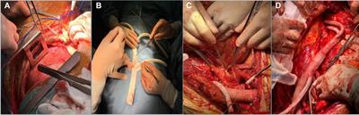 Clinical study of reoperation for acute type A aortic dissection